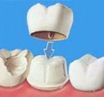 capsula dente