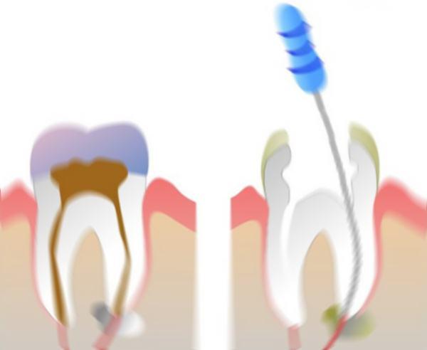 devitalizzazione-dente