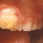 Lesione dente permanente