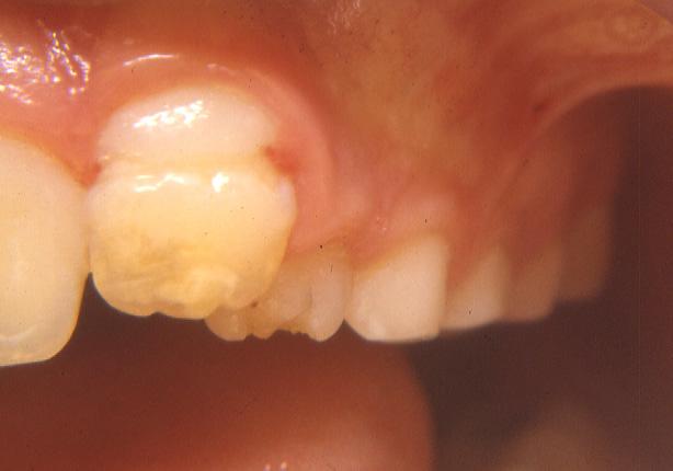 lesione-dente-permanente