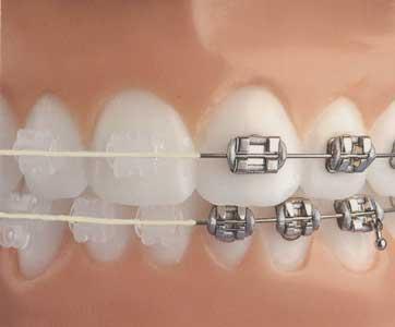 ortodonzia-tradizionale