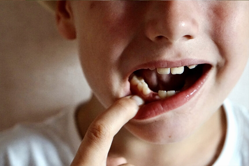 Agenesie dentali, ovvero la mancanza permanente e definitiva di qualche dente