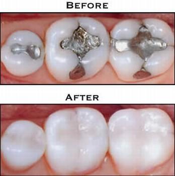 rimozione-amalgame-dentarie